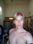 After a sunburn 5