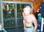 After a sunburn 2