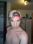 After a sunburn 4
