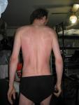 Red back from a warm shower